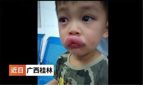 吃瓜过敏嘴巴肿胀,揭秘过敏反应背后的真相